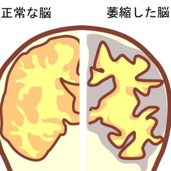 アルツハイマー型認知症の原因・特徴・進行過程、介護看護をどう計画する？
