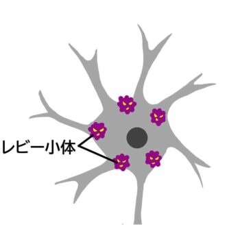 レビー⼩体型認知症の原因や症状、幻視やレム睡眠行動障害など大変な状態の介護対応